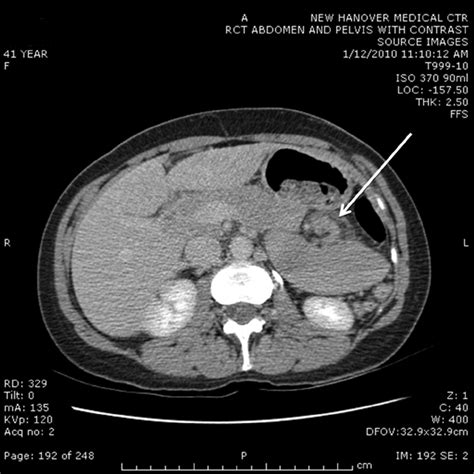 Axial View Ct Scan Of The Abdomen Note The Nonanatomic Position And