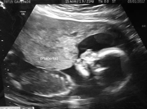 Pregnancy Update Fetal Echo And Gender Reveal