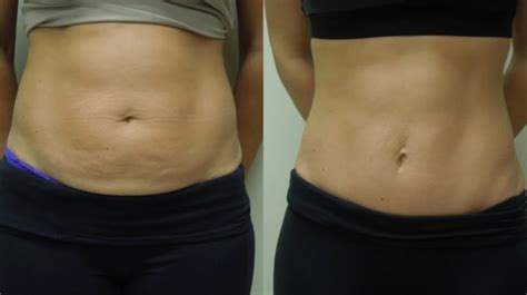 Mini Tummy Tuck Before And After