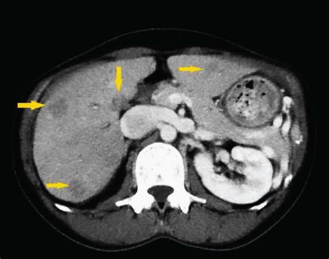 Ct Scan Showing Some Of The Multiple Ill Defined Liver Lesions