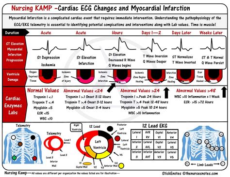 ST Elevations Monitoring For Infarction STEMI Electrocardiogram ECG EKG Cardiac And Telemetry