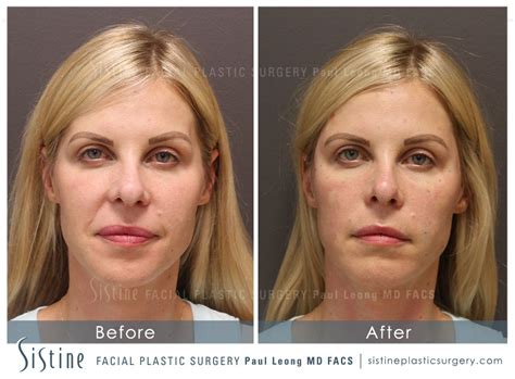 Restylane Juvederm Before And After 60 Sistine Facial Plastic Surgery