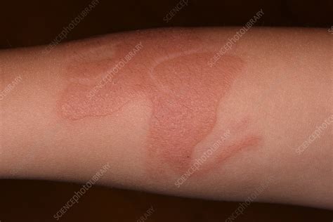Allergic Reaction To Henna Tattoo Stock Image C0564103 Science