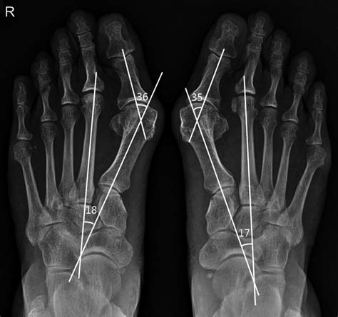 Hallux Valgus The Angle Between The Longitudinal Axis Of The 1st