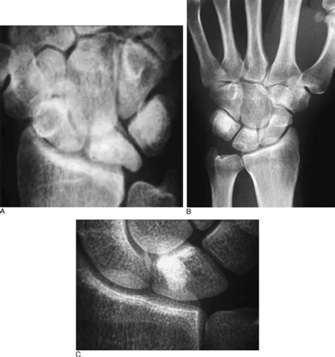 Arthroscopically Assisted Treatment Of Intraosseous Ganglions Of The Lunate Musculoskeletal Key