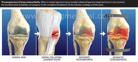 Progression On Knee Osteoarthritis Is Like Joint Gangrene The
