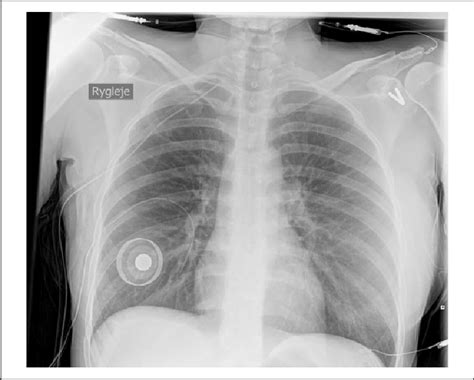 Chest X Rays Of The Patient After Insertion Of A Chest Tube And My