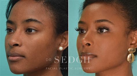 Female Rhinoplasty Before And After Photos Dr Sedgh