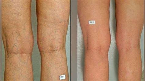 Varicose Vein Makeup For Legs