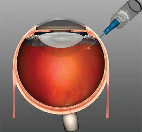 Intravitreal Injections Clio Eye Care Best Eye Clinic In Gurgaon