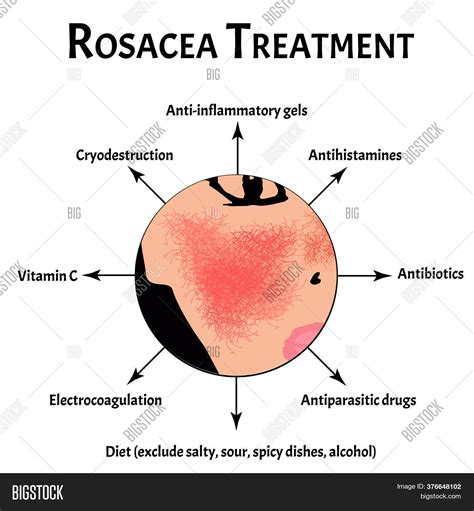 Causes Rosacea Image And Photo Free Trial Bigstock