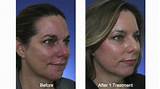 Laser Treatment To Remove Scars On Face Pictures