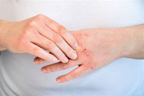 Hand Dermatitis In Covid 19 Times Hope Dermatology