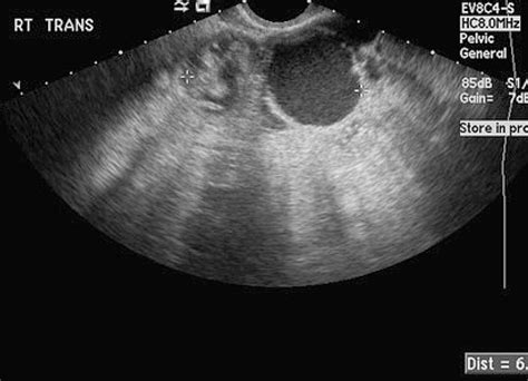 The Diagnostic Challenge Of Identifying Isolated Fallopian Tube Torsion