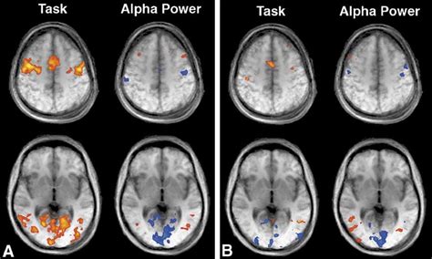 Activation Maps With Bold Mri Responses To Eyes Opening And Closing 2