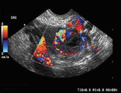 Transvaginal Color Doppler Of Ectopic Pregnancy Color Doppler