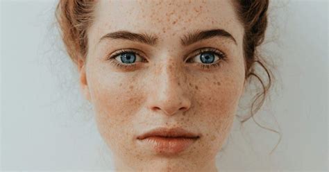 1what Causes Freckles 8 Things You Never Knew About Freckles Brain Berries Freckles