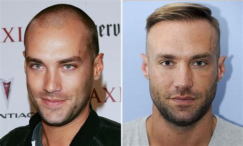Celebrities Hair Transplant Approved Stories