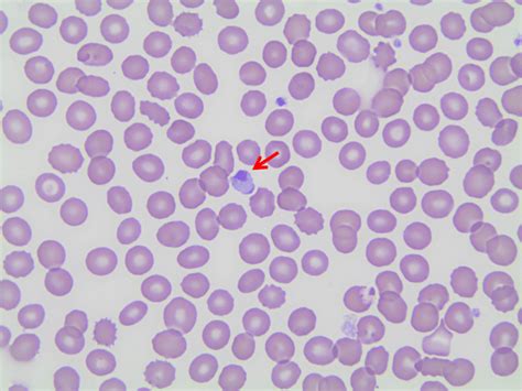 Peripheral Blood Smear With A Large Atypical Platelet Center Showing