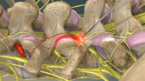 Watch Radiofrequency Neurotomy Of The Lumbar Facets