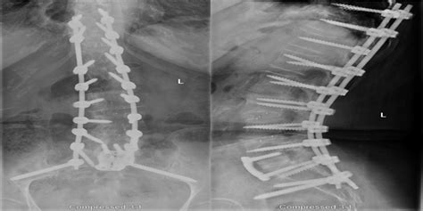 Feasibility Of Minimally Invasive Sacropelvic Fixation Perc Spine