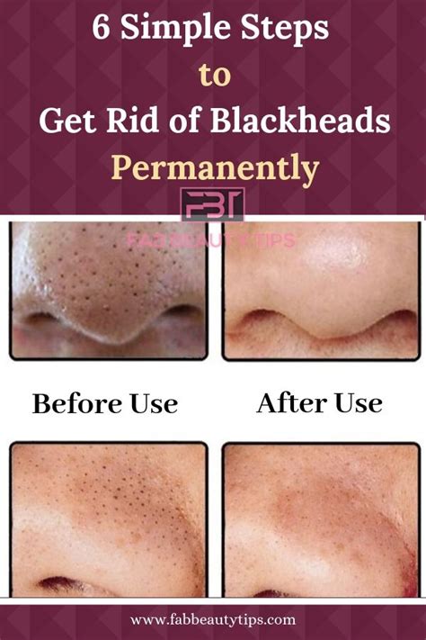 Six Steps To Get Rid Of Blackheads Fab Beauty Tips