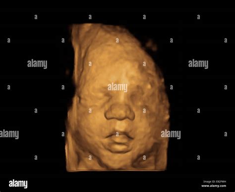 Foetus Face Coloured 3 D Ultrasound Scan Of A Foetus Gestational Age