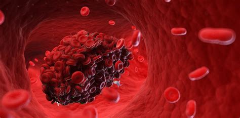 Blood Clots Five Reasons They May Happen
