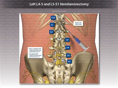 Left L4 5 And L5 S1 Hemilaminectomy Trial Exhibits Inc