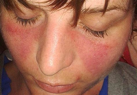 Lupus Dermatology Conditions And Treatments