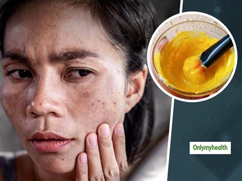 Dark Spots Try These Orange Peel Powder Face Packs For Acne Prone Skin