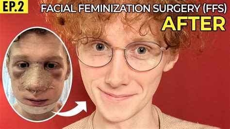 FFS Facial Feminization Surgery In Korea 3 Months Update Facial