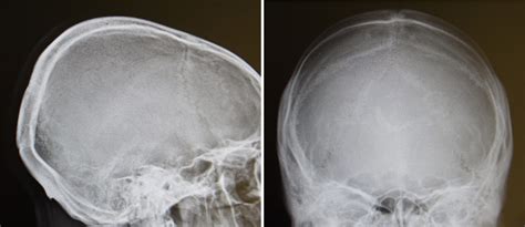 Blog Archivecase Study Occipital Skull Reduction