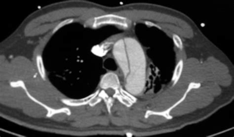 Aortic Dissection Radiology Aortic Dissection