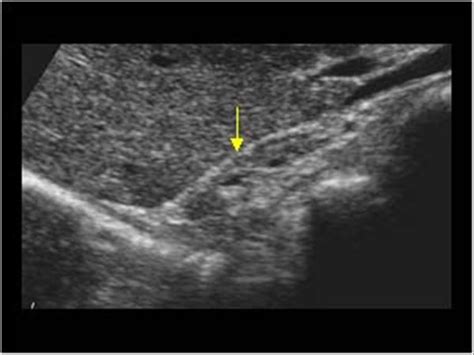 The Normal Adrenal Glands On Ultrasound Are Best Described As