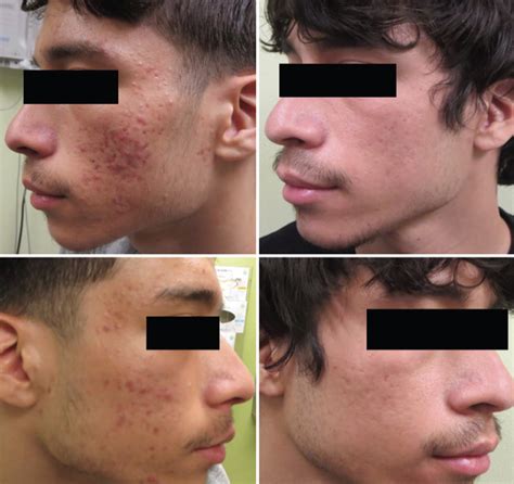 Laser Therapy For Atrophic Acne Scars A Case And Evidence Based