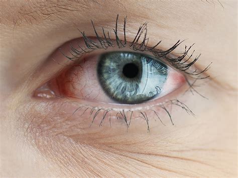 9 natural ways to relieve dry eye syndrome. The pathology of the syndrome of dry eyes - Carolinejoy Blog
