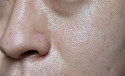 Oily Skin With Wide Pores In Face Of Southeast Asian Myanmar Or Korean