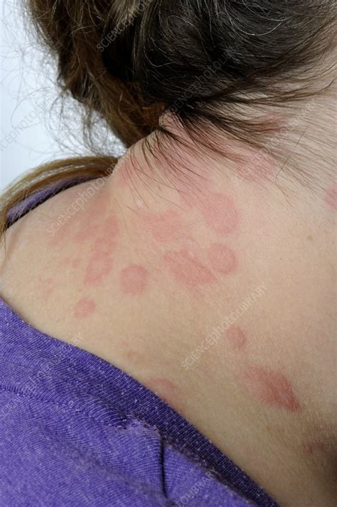 Urticaria On The Neck Stock Image C0117555 Science Photo Library