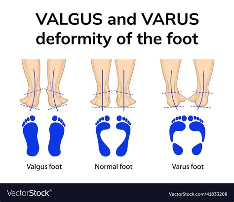 Varus And Valgus Deformity Of The Foot Royalty Free Vector