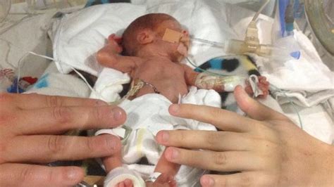 Melbourne Baby Born At 25 Weeks Gestation Is Thriving After His Early