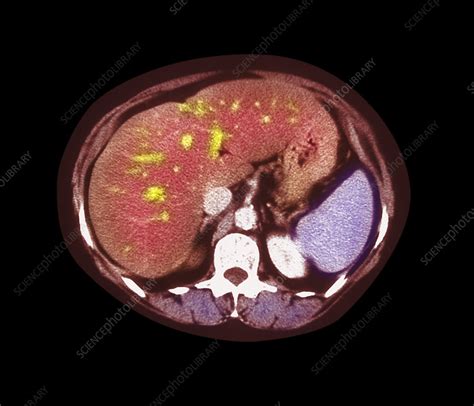 Fatty Liver Ct Scan Stock Image M2000154 Science Photo Library