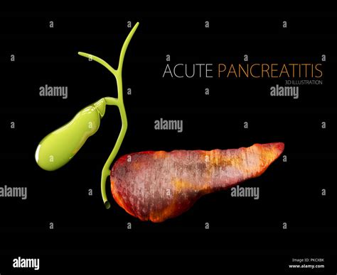Acute Pancreatitis 3d Illustration Inflammation Of Pancreas On A Black