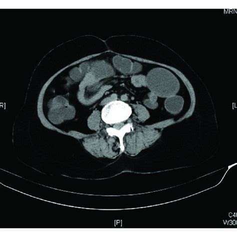 Computed Tomography Ct Abdomen Without Contrast Showing A Coronal