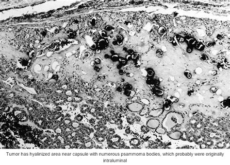 Pathology Outlines Oncocytic Hürthle Cell Tumors