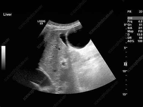 Polycystic Liver Disease Ultrasound Scan Stock Image C0178021