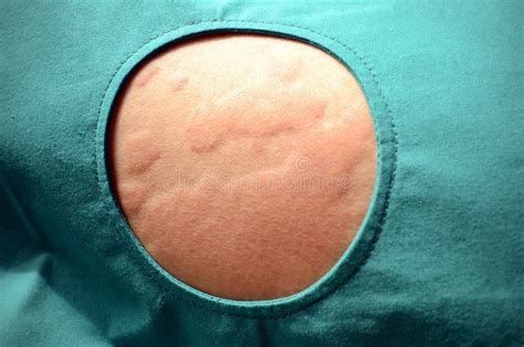 Skóry Wysypka Urticaria Alergiczna Skóry Reakcja Zdjęcie Stock