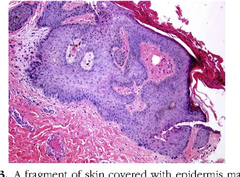 Pigmented Basal Cell Carcinoma Histopathology Loma Linda