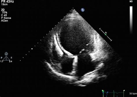 Fig 72 Two Dimensional Transthoracic Echocardiography Of Dilated