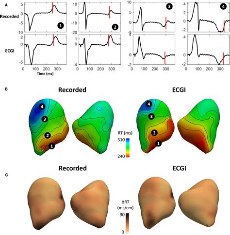 Electrocardiographic Imaging Of Repolarization Abnormalities Journal